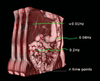 Imagen A: Mapa de frecuencia cuantificada de software representando la amplitud del movimiento de pixel durante una película dinámica de movilidad del intestino delgado (Fotografía cortesía de  A. Menys y S.A. Taylor, Hospital del Colegio Universitario, Londres, Reino Unido).